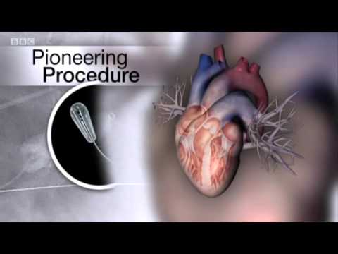 BBC TVHealth News from King's College Hospital London/Mitra-Spacer™