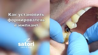 Как установить формирователь десны? Имплантация зубов Самара.