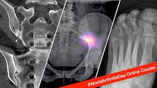 Understanding Imaging of Arthritis // A #WorldArthritisDay Initiative