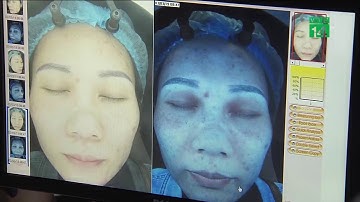 Nắng trên 38 độ C, đề phòng tia cực tím gây ung thư da | VTC14