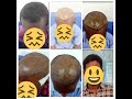After 10 months Growth See the Final Result,,Patient Is Very Happy
