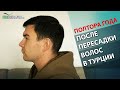 Пересадка волос на голове в Турции результат через полтора года. Minoxidil4you пересадка волос