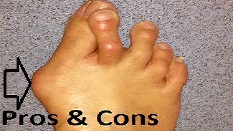 Big Toe Joint (MTP) Fusion Recovery ** Pros and Cons**