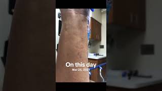 5 Year Back Anniversary