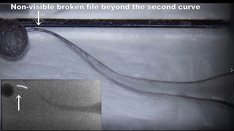 New technique to remove a non-visible broken file in a double curvature canal/S字根管内の見えない破折器具除去の改テク