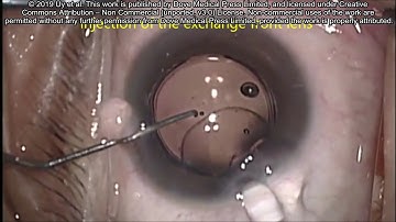 Enhancement outcomes of Precisight intraocular lens  – Video abstract [ID 188383]