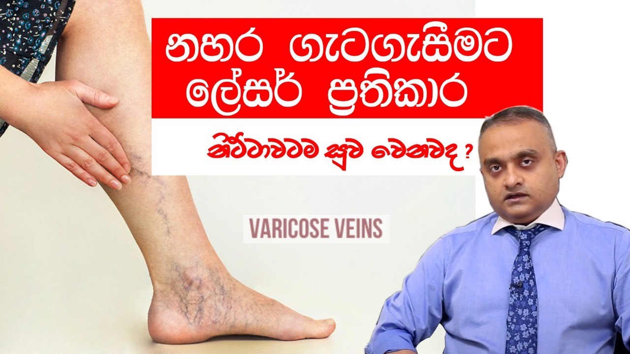 නහර ගැටගැසීමට ලේසර් ප්‍රතිකාර...නිට්ටාවටම සුව වෙනවද?