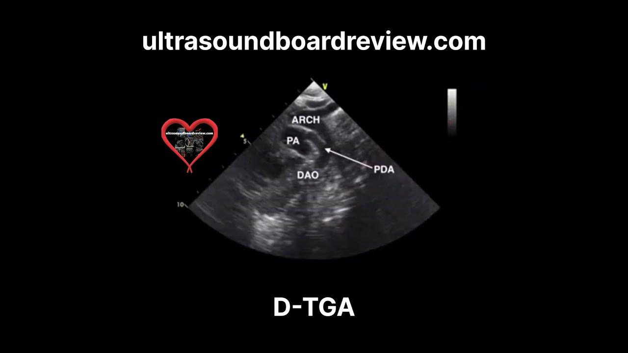 Transposition Of The Great Arteries (dTGA) Echocardiography YouTube 