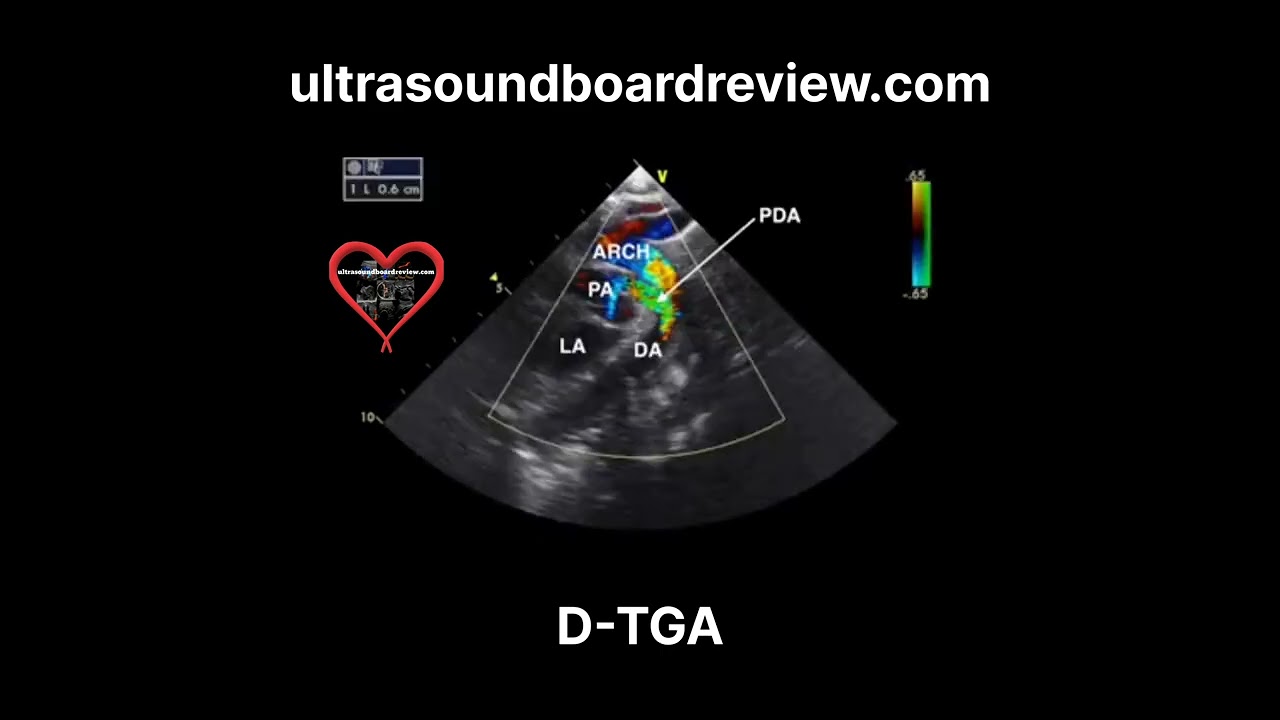 Transposition of the Great Arteries (d-TGA) Echocardiography
