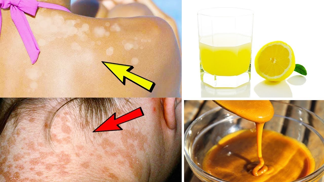 5 Effective Home Remedies For Treating Tinea Versicolor Home