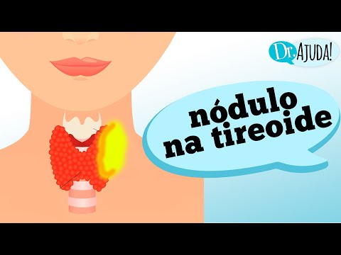 Quais os sintomas do NÓDULO NA TIREOIDE?