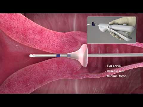 Video: Bagaimana sonogram dilakukan?