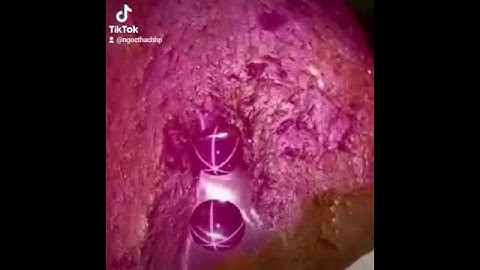 Top quality Stars Ruby from Vietnam mine. most expensive star ruby 390crt.