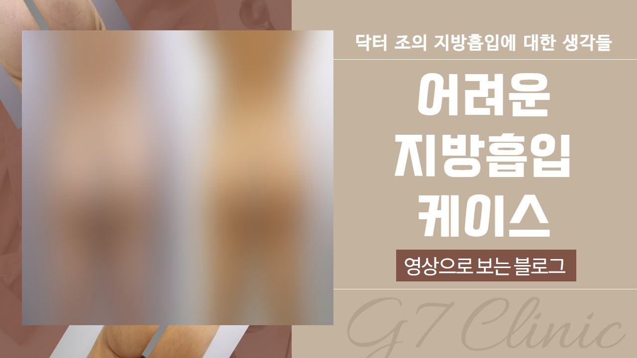 어려운 지방흡입 케이스 | 영상으로 보는 블로그 | 닥터 조의 지방흡입에 대한 생각들