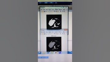 Liver Segmentation on CT and MR Using Laplacian Mesh Optimization- MATLAB PROJECTS