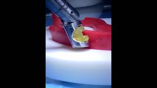 3D Printing an Innovative Suturing Device for Minimally Invasive Surgery