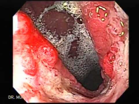 Video Clip of Stomach Cancer - YouTube