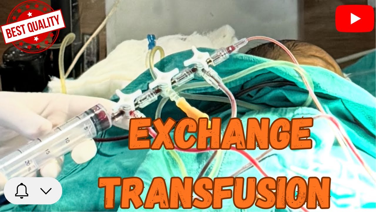 Exchange blood transfusion in newborn baby | 🩸Double volume exchange transfusion procedure 