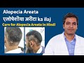 Alopecia Areata के कारण, लक्षण और घरेलू उपाय – Alopecia areata treatment in Hindi | गंजेपन का इलाज