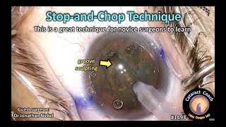 CataractCoach 1493: stop and chop phaco technique