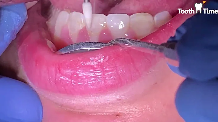 Rimuovi l'apparecchio - Risultati incredibili dopo 18 mesi! - Studi dentistico Tooth Time
