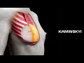 Round implants above the muscle / KAMINSKYI