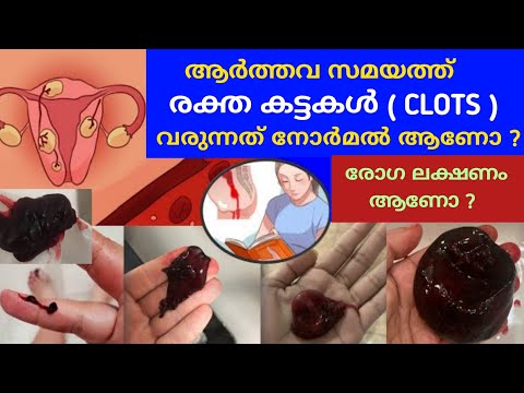 ആർത്തവ സമയത്ത്  (Clots) രക്തകട്ടകൾ വരുന്നത് നോർമൽ ആണോ ?