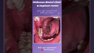 #bestdentist #wisdomtooth #wisdomtoothremoval #Mehsanadentalclinic #painlesssurgery #draftabkureshi