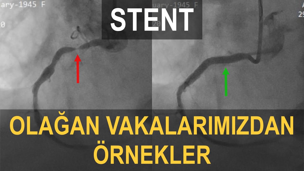 Stent 5 Stent