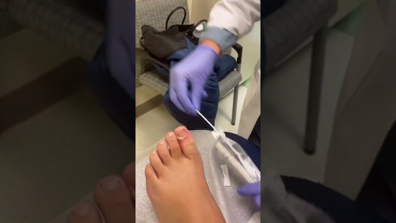 Big Toenail Removal & Pedicure Treatment YouTube