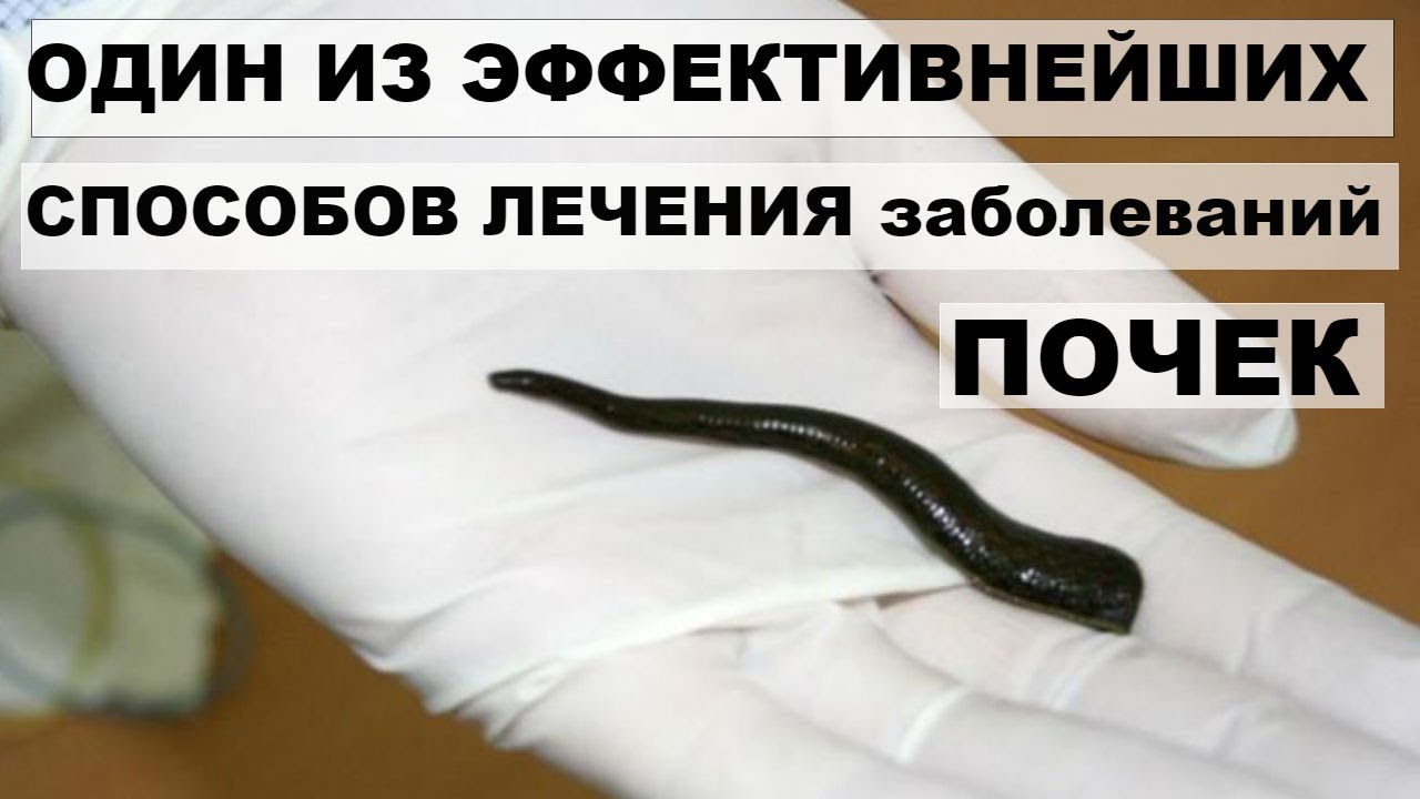 Воронеж Аптека Где Продаются Пиявки