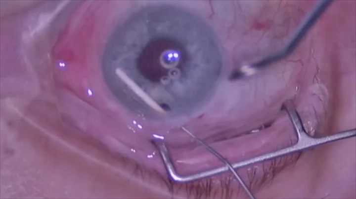 No-touch Technique for Removal of Dexamethasone (O...