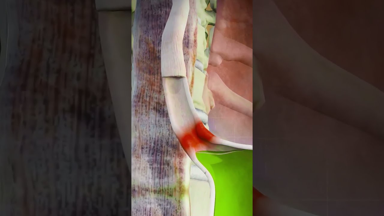 Acid Reflux Or GERD 3d Animation Asmrvideo Medical3danimation Digestivedisease