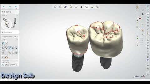 3shape design (simple case osstem implant) 4546