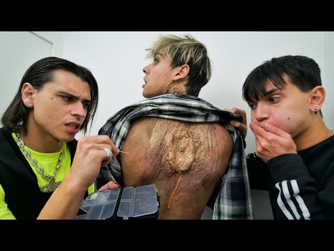 WE POPPED THE WORLD'S BIGGEST PIMPLE!