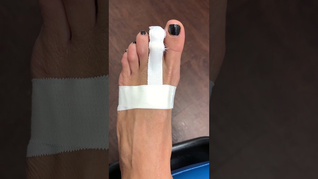 2 DAYS AFTER MINIMALLY INVASIVE TOE SHORTENING SURGERY 😁😁😁 YouTube