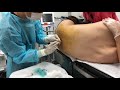 他院の再手術！静岡県からご来院の患者様の腰をもうひと絞りする！