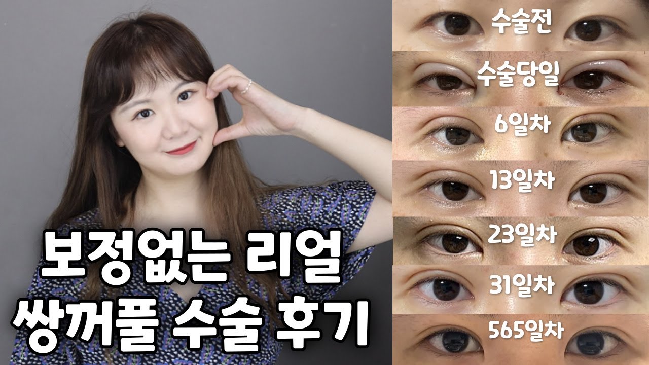 [쌍수 VLOG] 보정없는 리얼 쌍꺼풀 수술 후기 | 비절개 눈매교정 | 매몰쌍수 | 눈 지방제거 | 몽고주름 제거 앞트임 ...