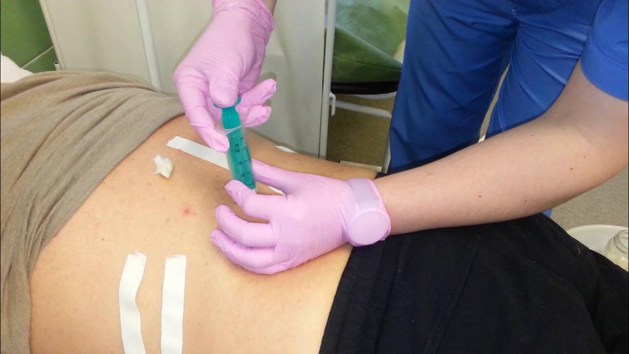 блокада уколов. блокада уколов. игла для блокады позвоночника. плазмотерапия коленного сустава. препараты для блокады позвоночника при грыже.