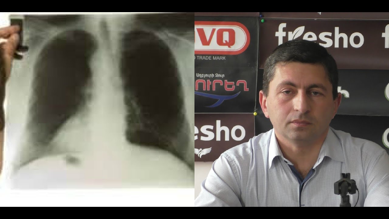 Տուբերկուլոզ հիվանդությունը չի կարելի անտեսել.ի՞նչ ցուցանիշներ ունենք վերջին տարիներին. Բժիշկ