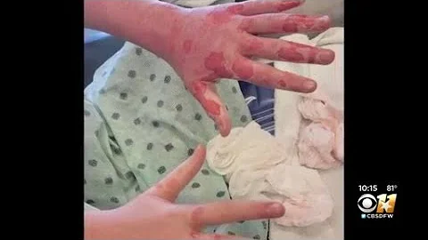 Playing With Fire, Granbury Teacher Resigns After Science 'Experiment' Goes Awry