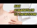 Как избавиться от папиллом | Лечение ВПЧ в домашних условиях