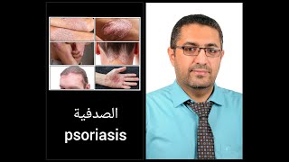 الصدفية psoriasis