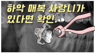 하악 매복사랑니.