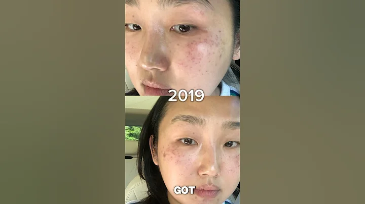 how to get rid of hyperpigmentation, sunspots, melasma with two products #skincare