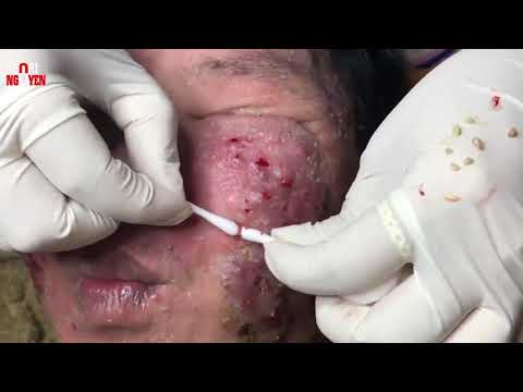 Severe Acne Infection Treatment   