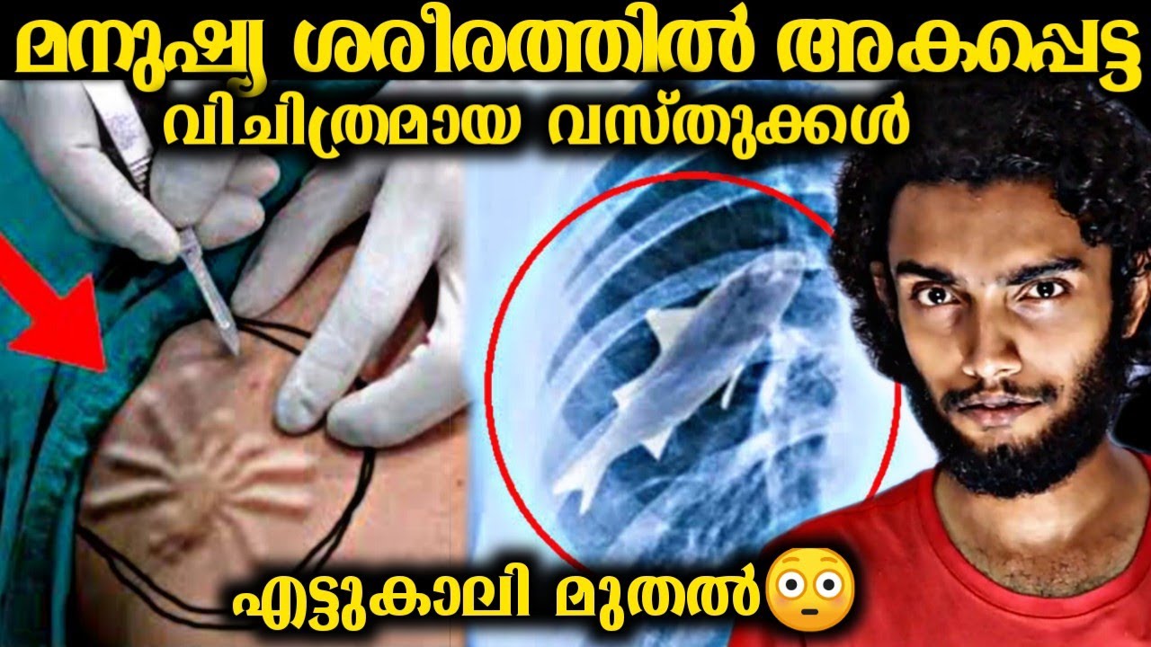 മനുഷ്യ ശരീരത്തിൽ കണ്ടെത്തിയ വിചിത്ര വസ്തുക്കൾ | Things Found Inside