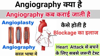 Angiography ओर Angioplasty कय ह कस करन चहए एजयगरफ कस हत ह