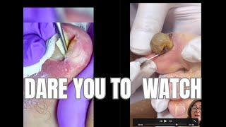 Watch As We Remove 5 Satisfying Infected Ingrown Toenails