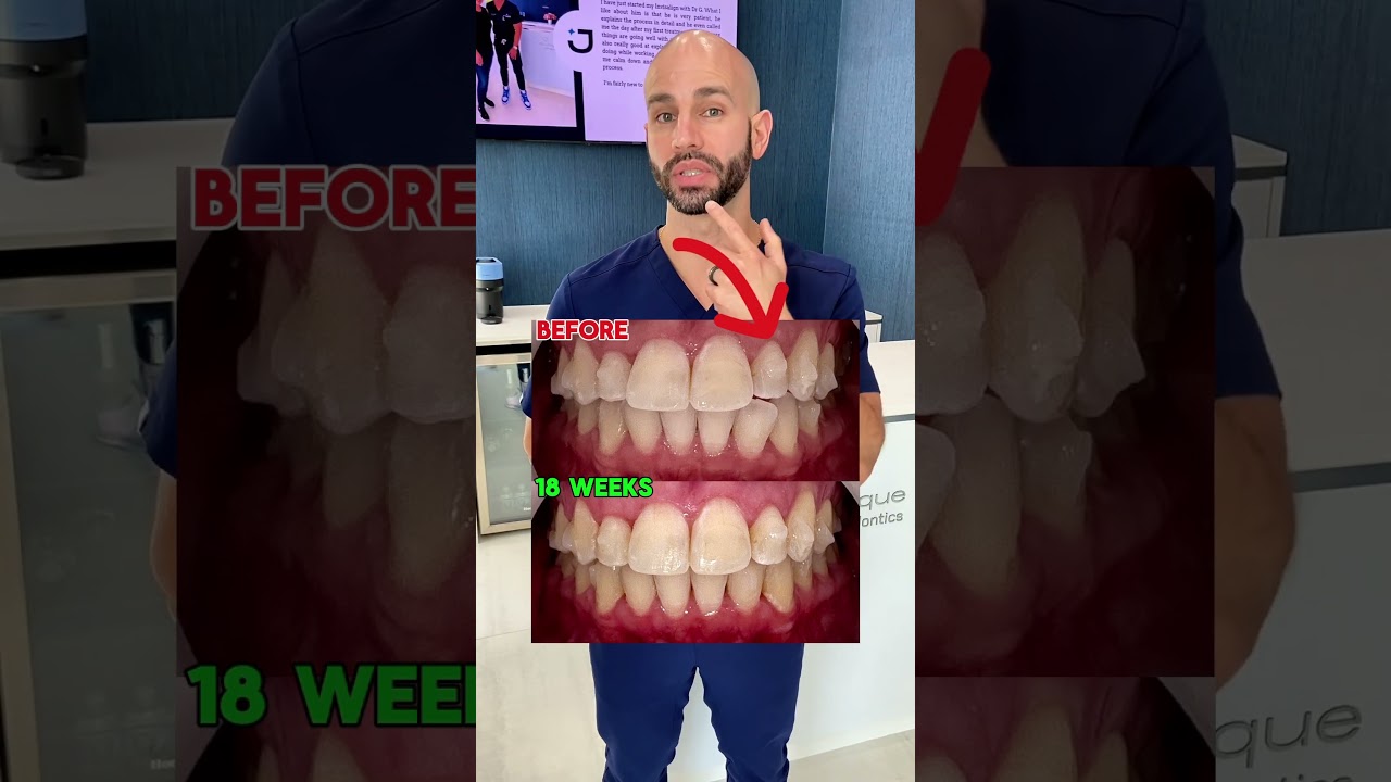 Adult Invisalign Case Review (2025)